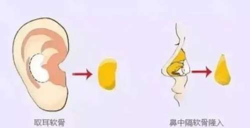 隆鼻 隆鼻