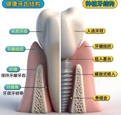 牙齿种植 牙齿种植