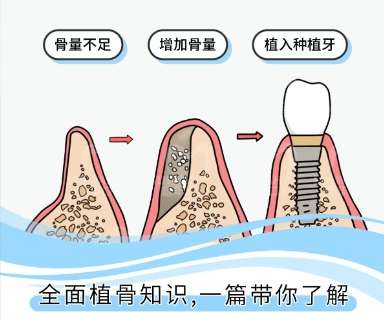 牙齿种植 牙齿种植