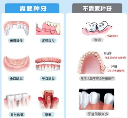 牙齿种植 牙齿种植