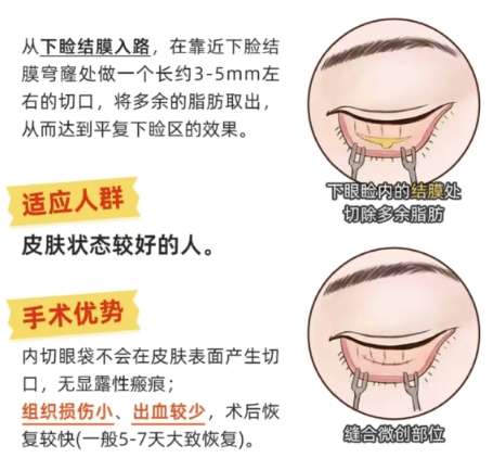 去眼袋 去眼袋