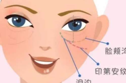 玻尿酸填充泪沟有鼓包动漫01.jpg