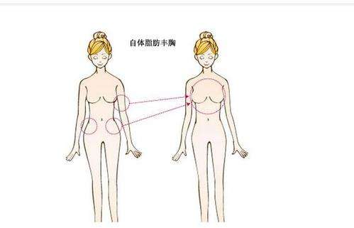 自体脂肪隆胸是什么.jpg