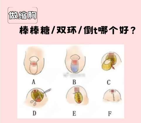 缩胸 缩胸
